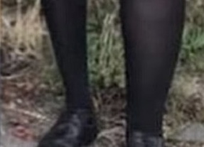 تعاني من حالة نادرة تتسبب بتضخم