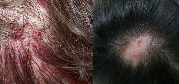 أسباب الرائحة الكريهة في فروة الرأس