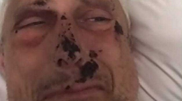 بتر ساقي رجل نجا بأعجوبة من