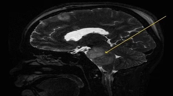يعاني من الحازوقة 4 أشهر بسبب