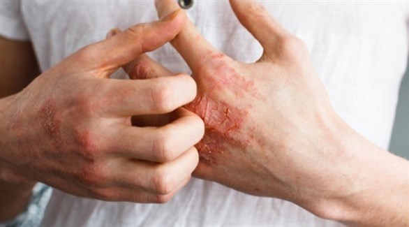 منها الحكة.. . أعراض الإصابة بالإكزيما
