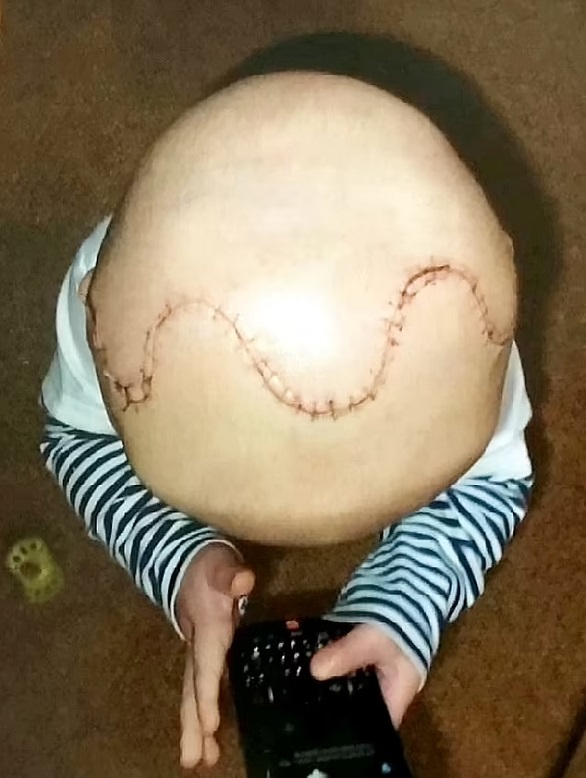 جراحون يعيدون تركيب جمجمة طفل