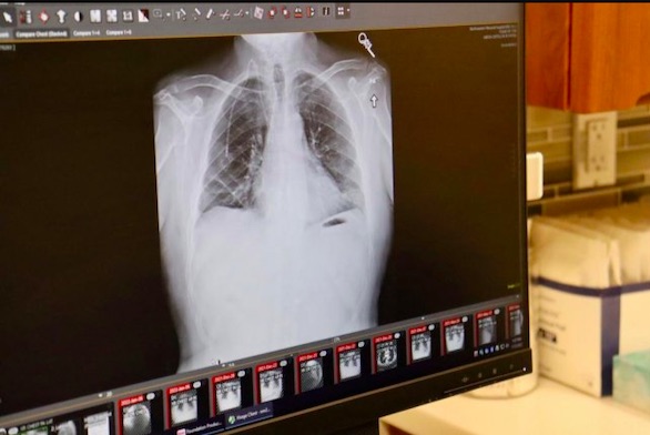 عملية زرع رئتين مزدوجة تنقذ حياة