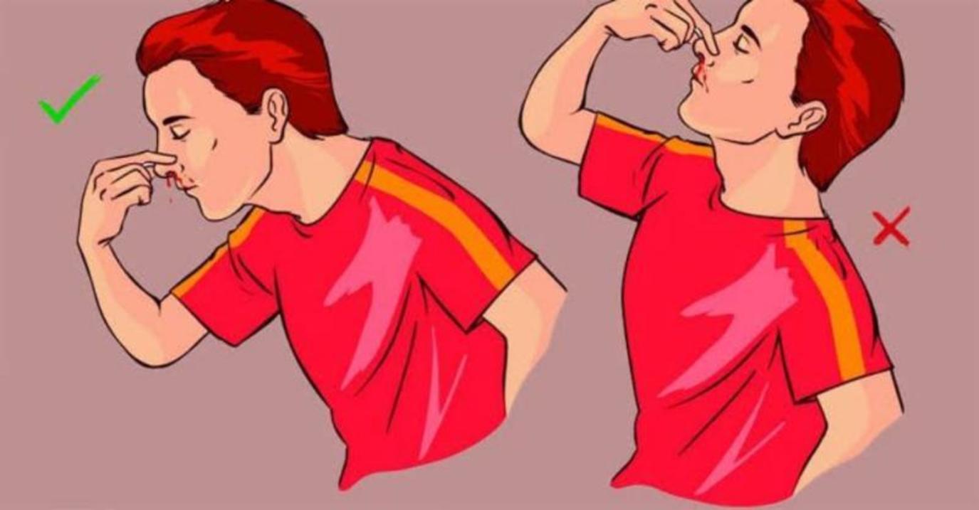 نزيف الأنف قد ينذر بالإصابة بمرض