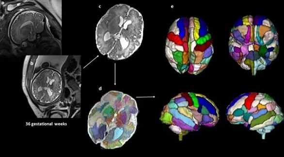مرض التوحد يمكن اكتشافه لدى الأطفال