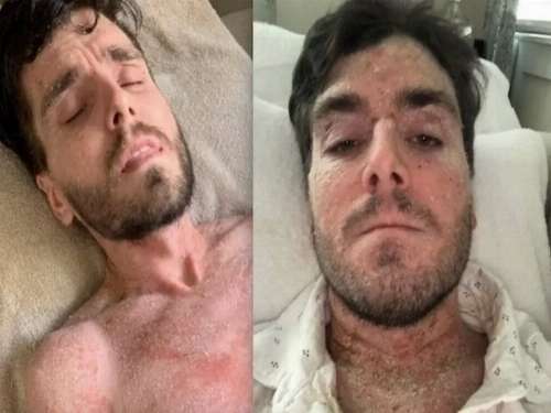 يعالج نفسه بتناول الماء بعد إصابته