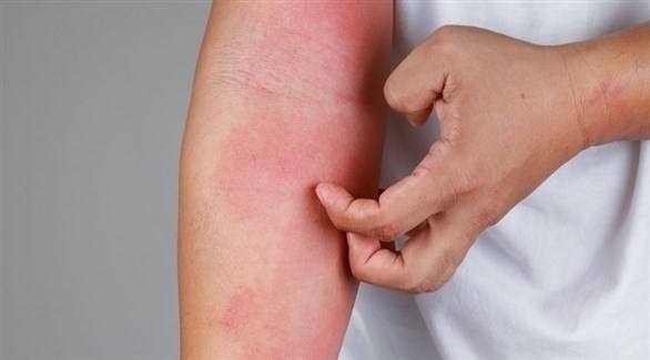 ما الرابط بين الإكزيما والاكتئاب؟