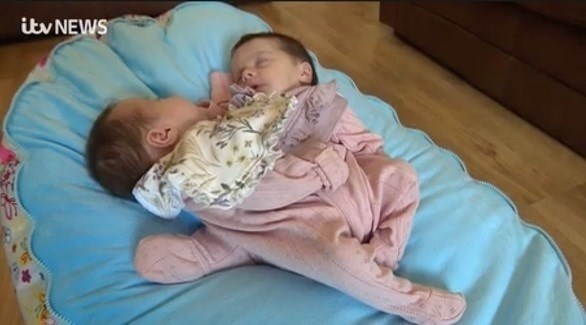 يرزقان بطفلتين ملتصقتين في حالة نادرة