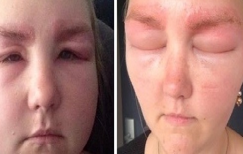 تحوّلت لمومياء.. تعاني من انتفاخ شديد