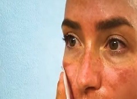 تصاب بتلف في البشرة بسبب الإبحار