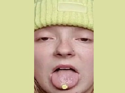 ينمو الشعر في لسانها بسبب حالة