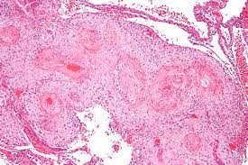 ضغط الدم الحملي مؤشر على خطر