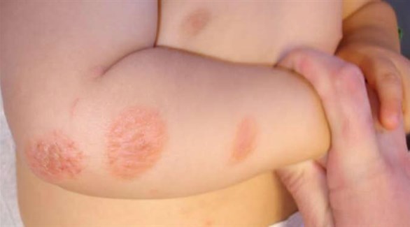 طفلك مصاب بالتهاب الجلد العصبي؟ نصائح