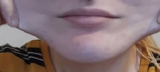 تعاني من حالة تتسبب في تشقق