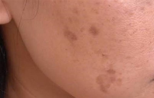 هكذا تواجهين البقع الصبغية على الجسم