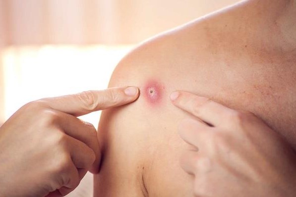 كيف تقي نفسك من جدري القردة