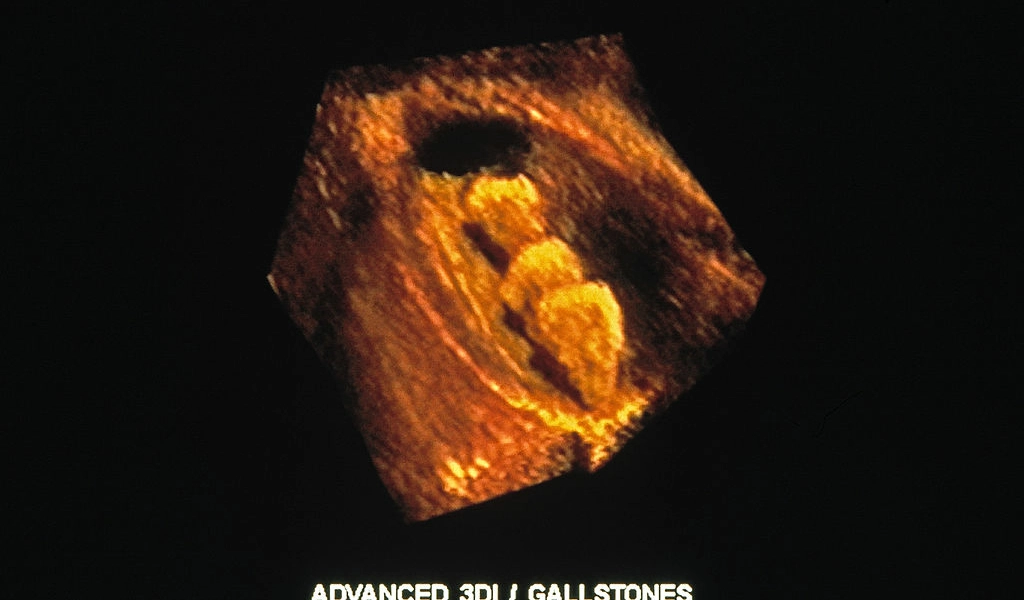 إزالة أكثر من 200 حصوة من