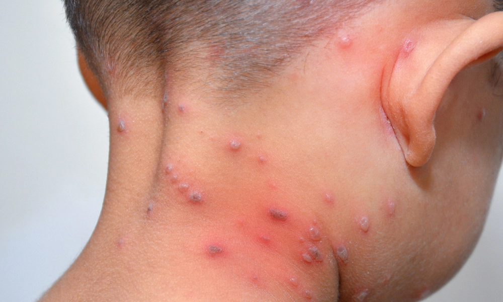 جدري القرود ينتشر في 14 دولة