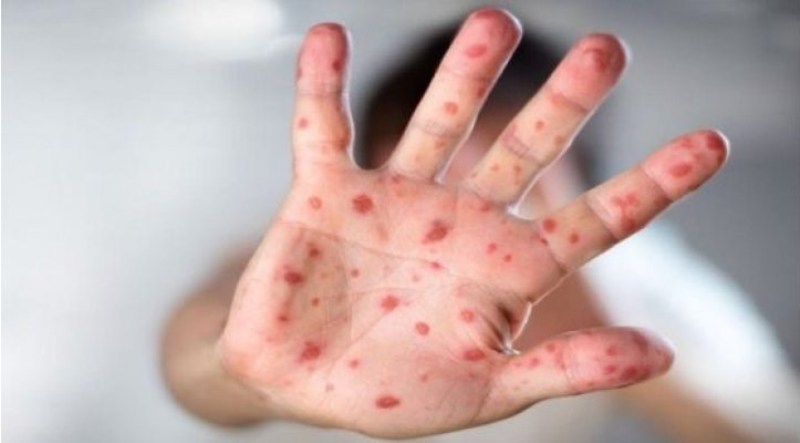 طبيب أردني عن جدري القردة: لا