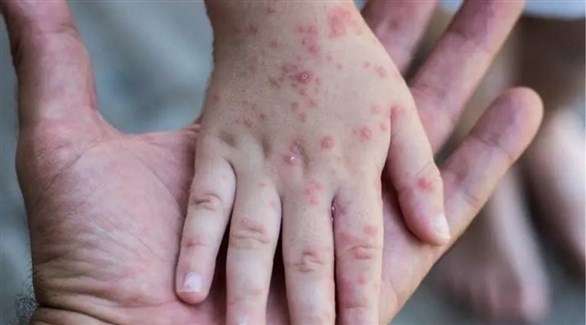 فرنسا: ارتفاع حالات الإصابة بجدري القردة