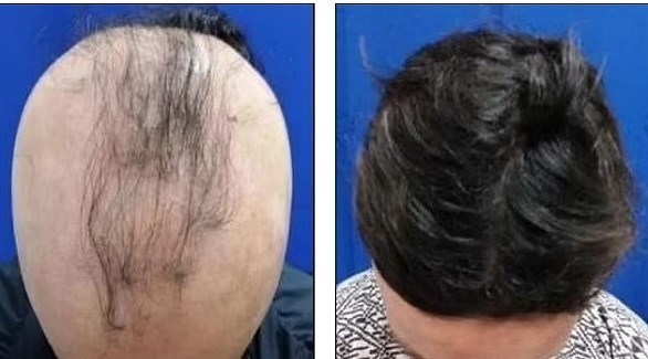 عقار ثوري فعال لحل مشكلة الصلع