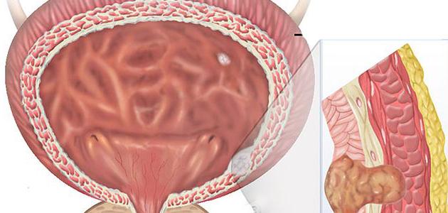 النساء أكثر عرضة لالتهاب المثانة