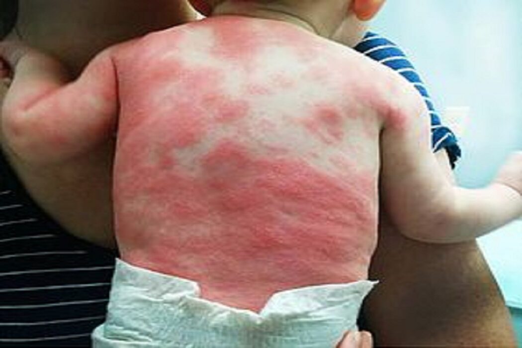 ماليزيا تغلق رياض أطفال بعد انتشار