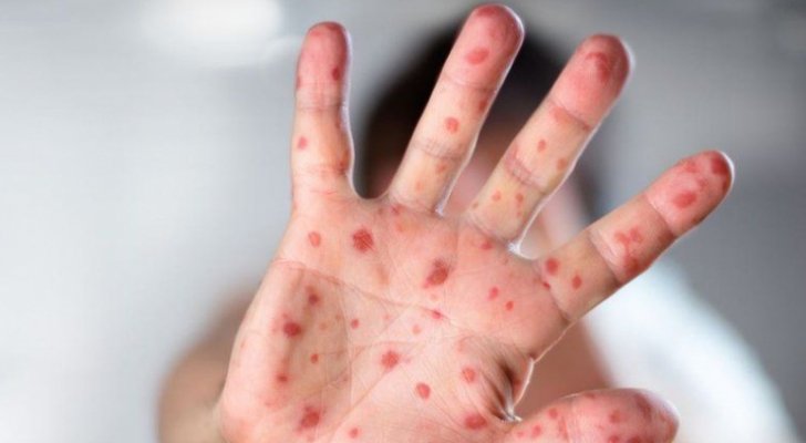 الصحة العالمية: خطر انتشار جدري القرود