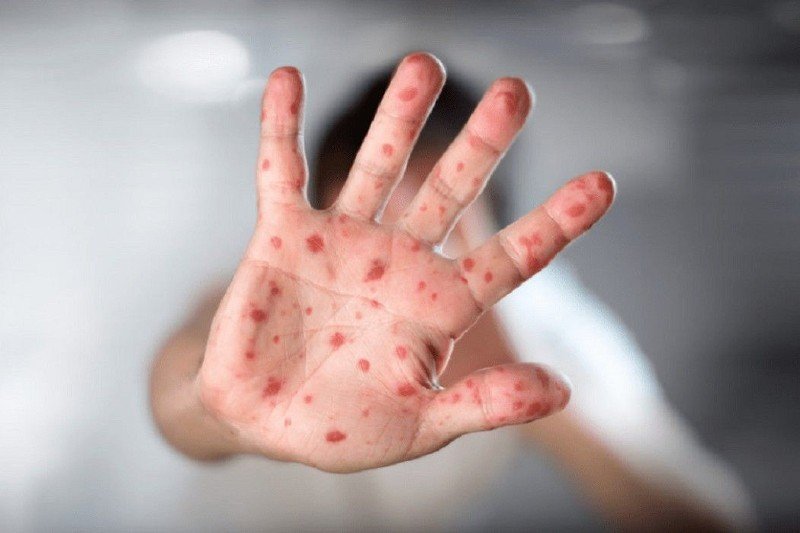 نمط انتشار مقلق.. الصحة العالمية تتحدث