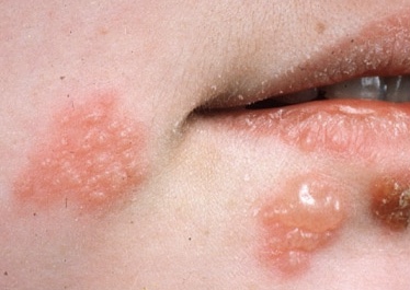 ما قصة البثور والتقرحات حول الفم؟