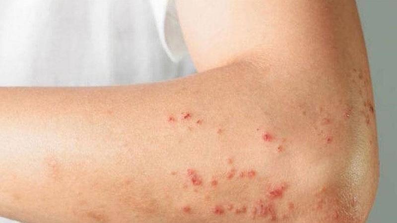 لبنان يسجل أول حالة إصابة بجدري