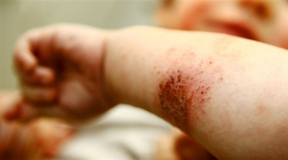 ماذا تعرفين عن التهاب الجلد الضوئي