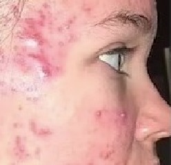 مكوّن في سمك القرش يحارب حب