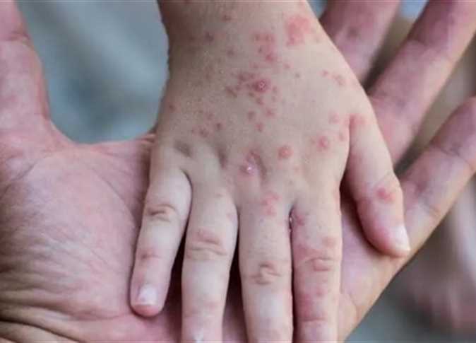 تسجيل أول إصابة بمرض جدري القردة