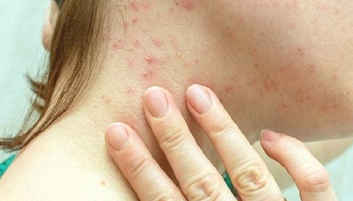 جدري القردة.. تسجيل أولى الوفيات خارج