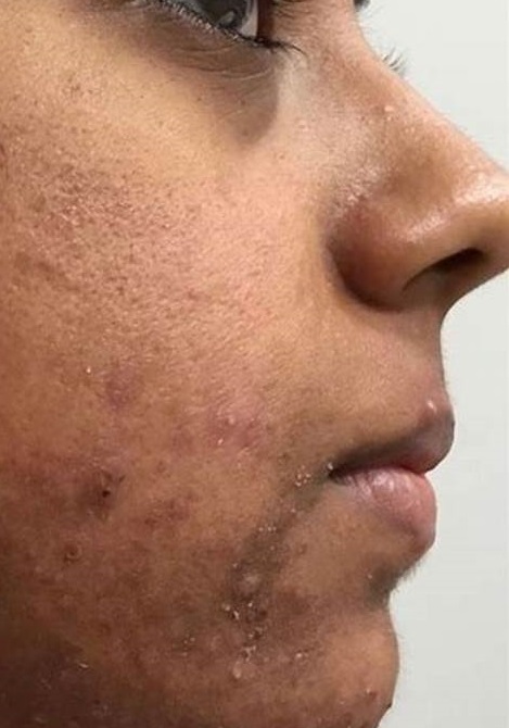 يمكنك إزالة آثار الحبوب من البشرة