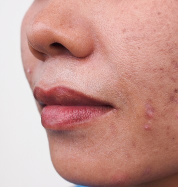 هكذا يمكنك إزالة آثار الحبوب من