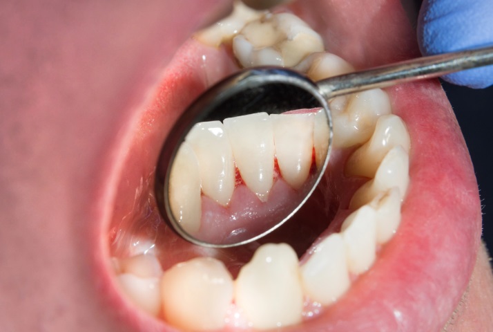 تنظيف أسنانك بطريقة خاطئة قد يصيبك