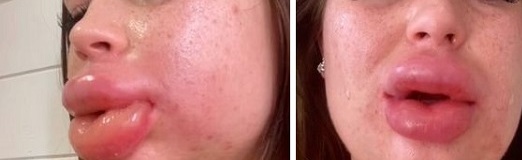 نتيجة كارثية لامرأة حاولت إزالة الفيلر