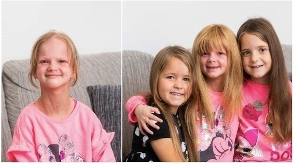 الاكزيما ومشاكل الشعر