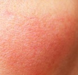 هل يصعب التعامل مع البشرة الحساسة؟