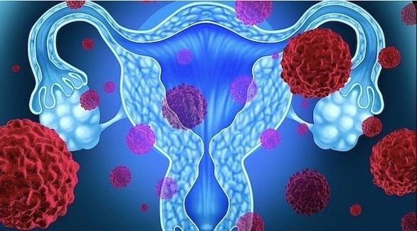 اختبار جديد يكشف السرطان لدى النساء