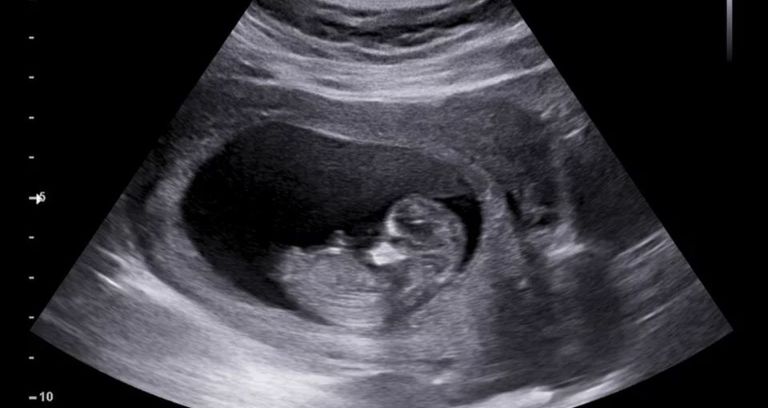 الأطفال الحجريين.. قصة سيدة حملت جنينا