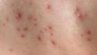 طرق الإفلات من متلازمة الجلد المحمص