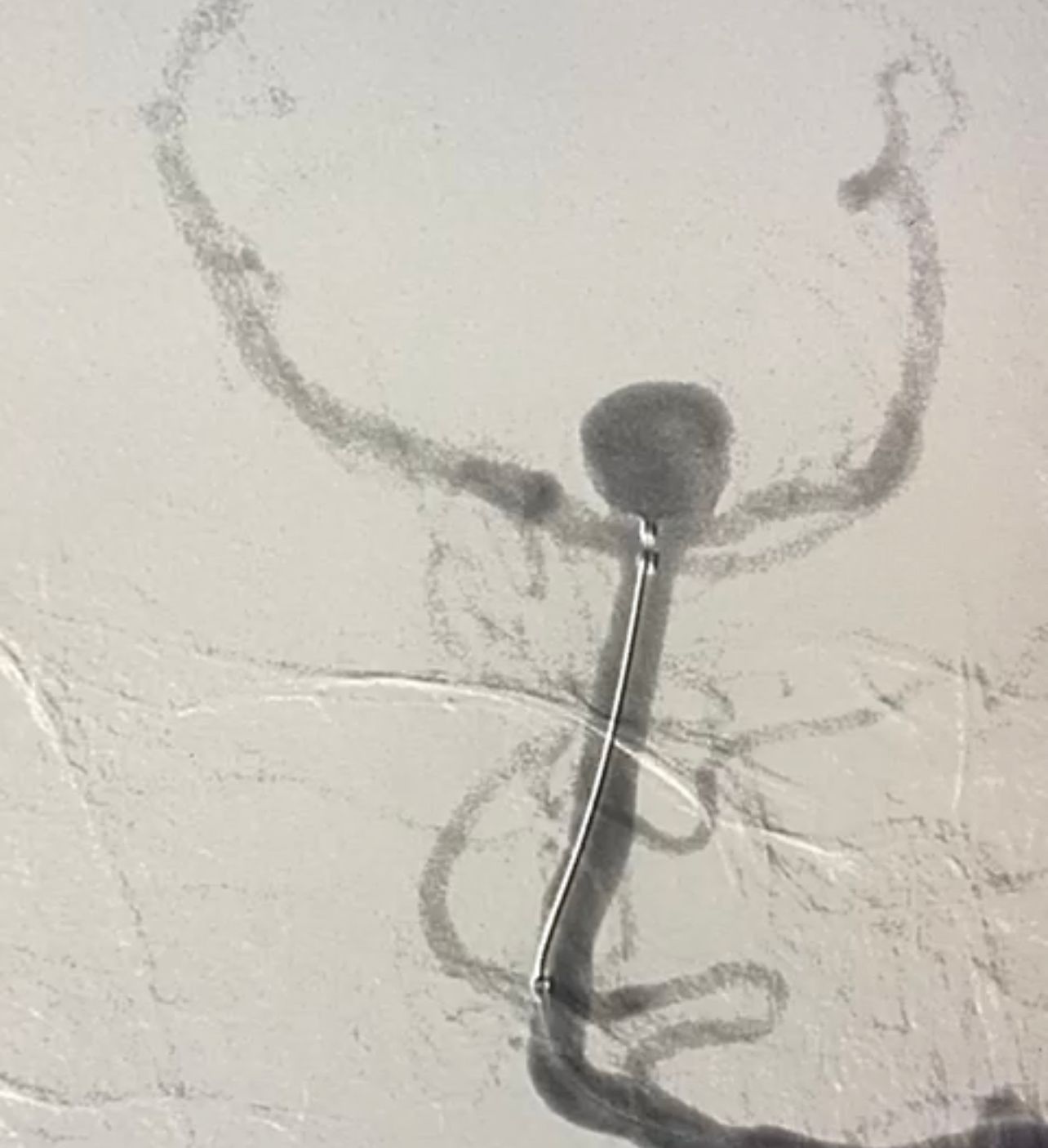 ادخال تقنية طبية حديثة لعلاج الأكياس