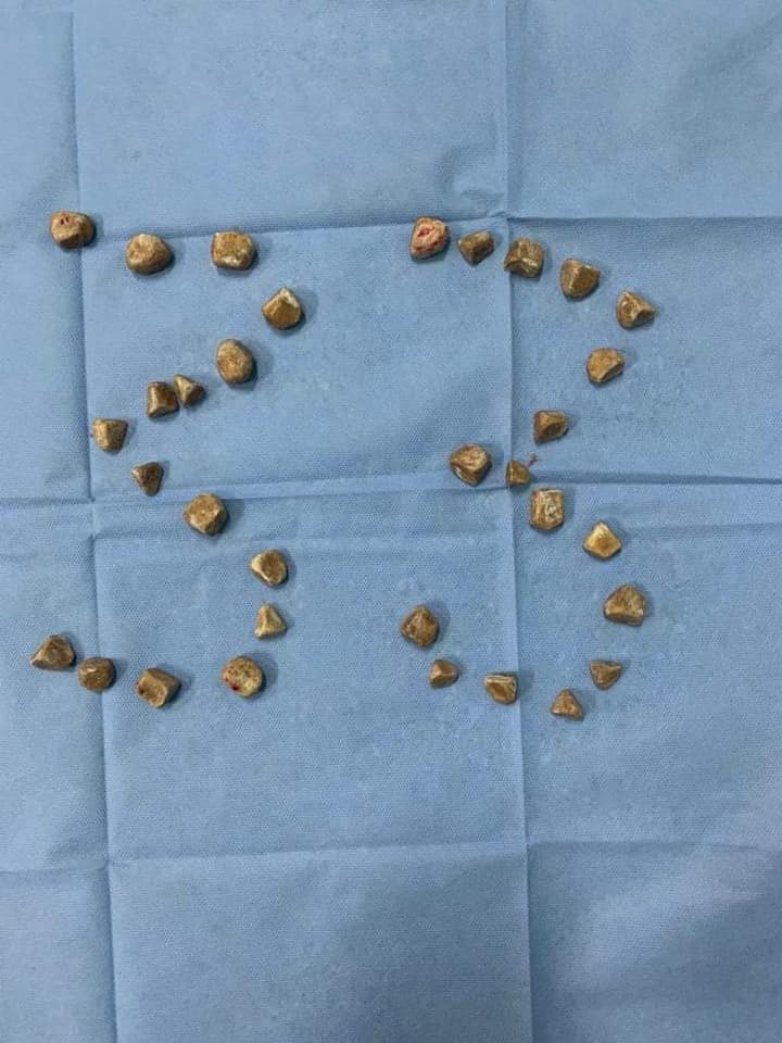 33 حصوة في مثانة خمسيني اردني