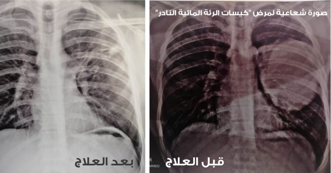 في يومها العالمي.. الأمراض النادرة بين