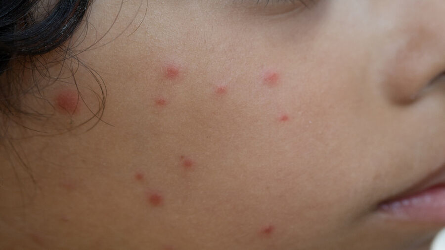 رقم قياسي لمصابي جدري الماء العام