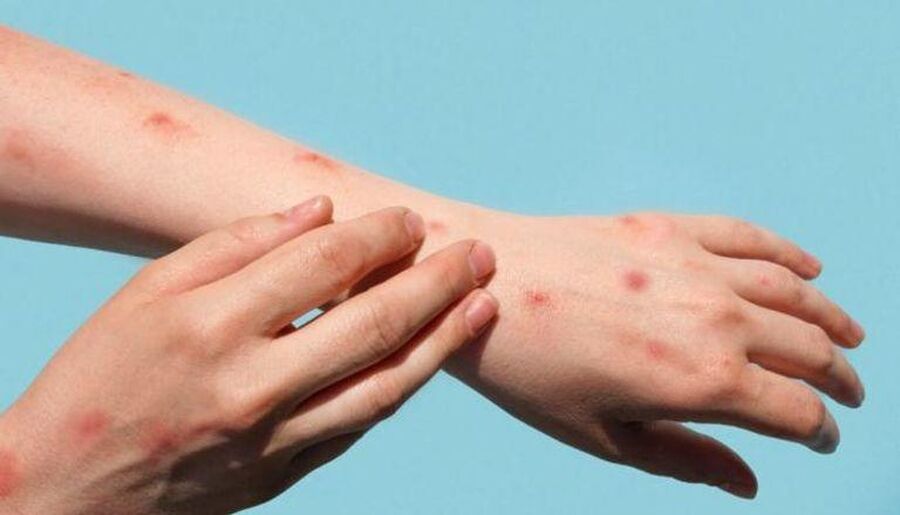 الصحة العالمية: جدري (إم بوكس) لم