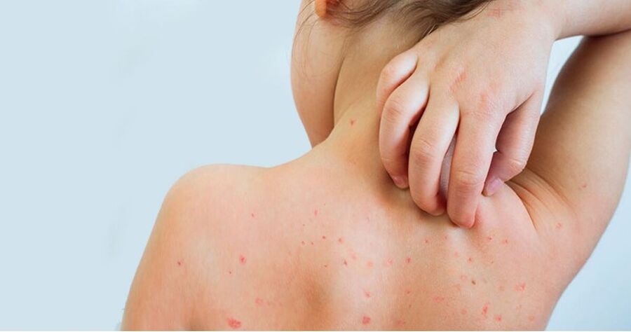 الصحة تحذر بعد تسجيل 27 إصابة